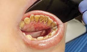 Image result for Plaque