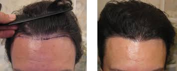 Using breakthrough technology & customized treatment plans. Before After Hair Transplant Photos La Jolla Hair Graft Gallery San Diego