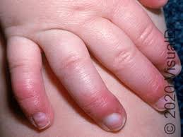 Image result for Chilblains