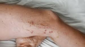 Reticular Veins Potential Dangers Pictures Treatments And More
