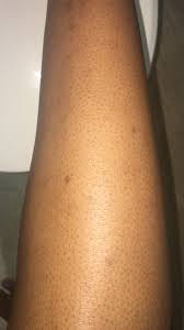 Our laser hair removal team in atlanta has years of experience treating patients for unwanted hair. Is Laser Hair Removal The Best Way To Correct My Dark Pores Photo
