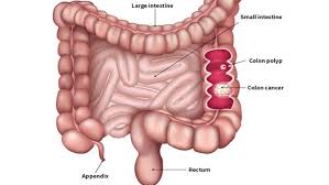 You may notice blood on the toilet paper, in the toilet, or mixed with your stool after a bowel movement. Rectal Bleeding Is Not Only The Common Sign Of Hemorrhoids