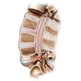 Image result for where to get treatment for herniated disc