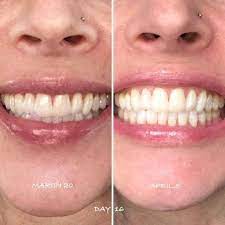 Carbon coco natural teeth whitening. 19 Teeth Whiteners That Work So Well It S Basically Magic