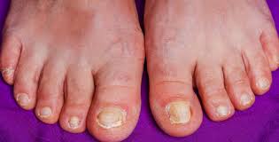 Image result for mykoza nehtů