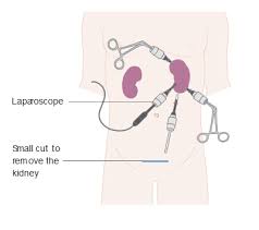 Kidney Cancer Symptoms Diagnosis Treatment Urology