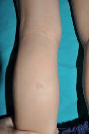 Even though the spots are harmless themselves, they are usually the earliest sign for neurofibromatosis. An Update On Neurofibromatosis Type 1 Not Just Cafe Au Lait Spots Freckling And Neurofibromas An Update Part I Dermatological Clinical Criteria Diagnostic Of The Disease Sciencedirect