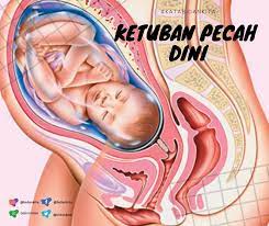 Ish, ni air apa ni? Ketuban Pecah Dini Kpd Atau Premature Rupture Of The Membrane Prom Bidan Kita
