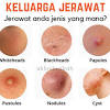 Wajah yang berjerawat tentu terasa tidak nyaman dan membuat malu dan minder. 1