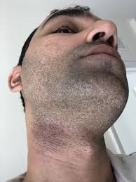 It is important to take care of yourself, especially because we give so much as women, so i'm making electrolysis a priority for me. Does Laser Hair Removal Work On Dense And Thick Beard Hair That I Have Photo