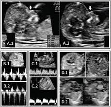 Prenatal Diagnosis Of Down Syndrome Intechopen