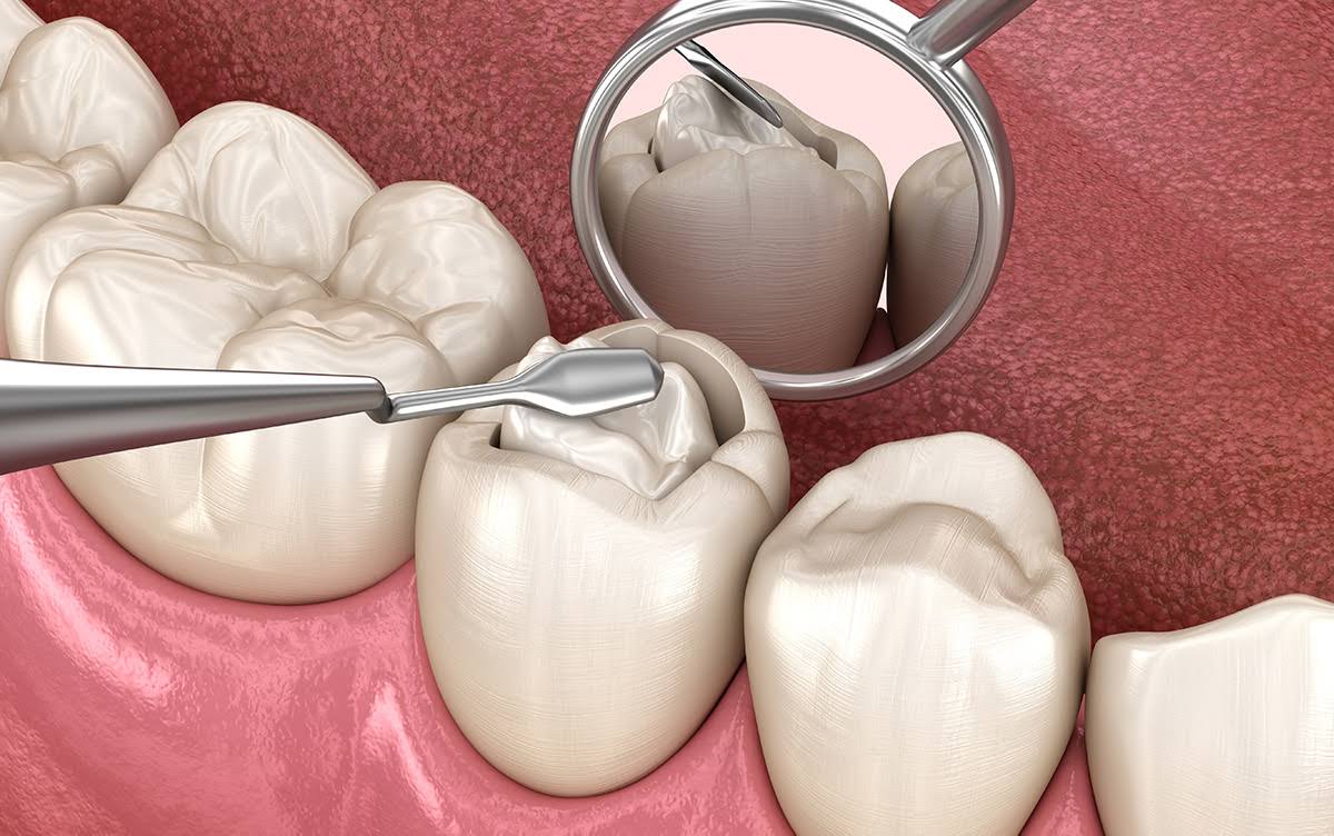 Dental Fillings treatment product image