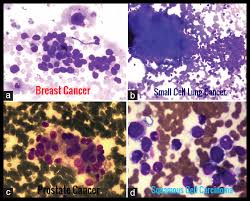 Bone marrow transplants have now seemingly cured a second man of hiv after he was being treated for an aggressive form of cancer. Malignant Infiltration Of Bone Marrow Ask Hematologist Understand Hematology