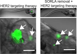 Despite encouraging advances in breast cancer treatment that have dramatically prolonged survival even when diagnosed at a metastatic stage, there still is a significant group of less fortunate patients that die from this condition every year. Novel Therapy Resistance Mechanism Promoting The Growth Of Breast Cancer Brain Metastasis Eurekalert Science News