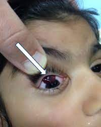 Maybe you would like to learn more about one of these? A Fleshy Mass Emerging From Beneath An Eyelid Journal Of Emergency Medicine