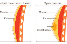 Image result for Gynecomastia
