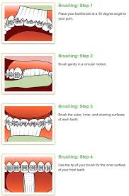 We all probably understand that brushing our teeth is vital to good dental health, especially with a. Thomas Orthodontics On Twitter Brushing Your Teeth With Braces Has Its Technique That S Why We Re Here To Help