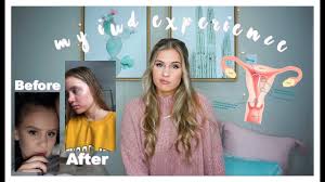 Other hormonal iud side effects may be very similar to other hormonal birth control side effects. My Iud Mirena Experience Insertion Removal Side Effects More Youtube