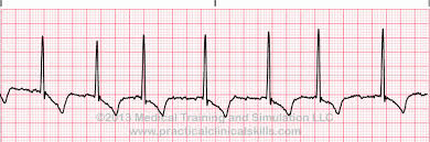 atrial fibrillation a fib learn and practice