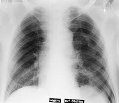 Pneumothorax develops when air enters the pleural space as the result of disease or injury. Pneumothorax Wikiwand