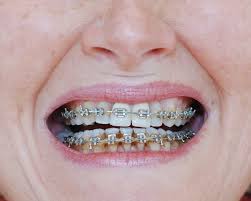 Those allergic to peroxide should askmen may get paid if you click a link in this article and buy a product or service. How To Prevent Teeth Staining While Wearing Braces Orthodontic Specialists Of White Plains