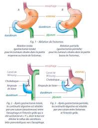 Cancer de l'estomac et causes. Cancer De L Estomac Chirurgie Lecancer Fr