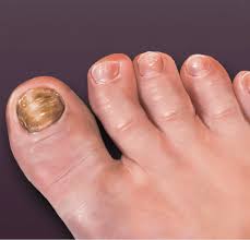 Image result for Onychogryphosis feet