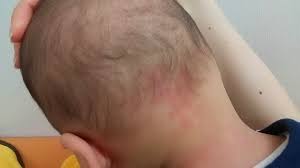 赤ちゃん 首 の 後ろ 赤い