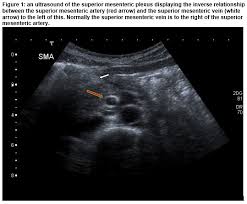 Image result for Intestinal Malrotation