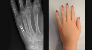 Image result for Hand Fracture