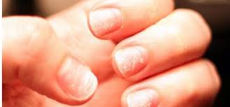 9 Things Your Fingernails Reveal About Your Health Remove Acrylic Nails Nails After Acrylics White Spots On Nails