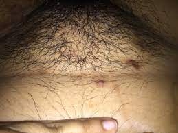 I have extreme ingrown hairs in my pubic area and bikini line. I Have Extreme Ingrown Hairs On My Pubic Area Would Laser Treatment Be Best Photos