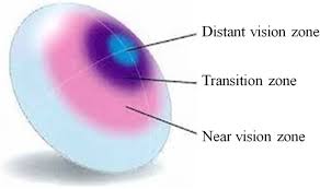 It is a procedure that comes with a high rate of success. Clinical Study On The Effect Of Multifocal Contact Lenses On Myopia Progression In Myopia School Children Trials Full Text