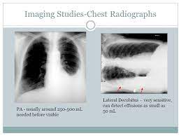 • contrasted ct • split pleura sign. Pleural Effusion Marvin Chang Pgy2 April Ppt Download