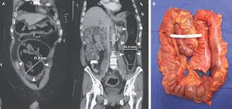 Image result for Megacolon