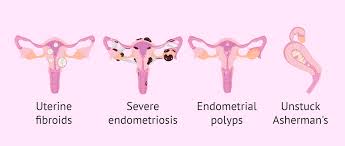 Müllerian duct anomalies (mdas) are congenital abnormalities that occur when the müllerian ducts (paramesonephric ducts) do not develop correctly. Mullerian Duct Anomalies And Uterine Diseases
