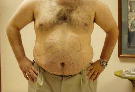 Newest listings freedom tattoo llc. Liposuction Before And After Photos By Joe Griffin Md Florence Sc Case 22856 Asps