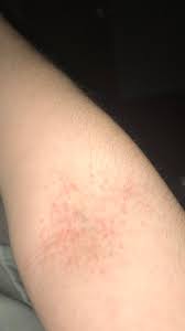 In most cases, itchy skin rash appears to be mild initially. I Have This Rash It And Its Not Itchy Help Me Please It Hasn T Gone Away And The Picture Was When It Was At Its Worst Please Help Askmedical
