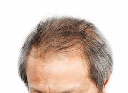 Ainsi, une femme de 60 ans possède la on estime qu'une perte de plus 100 cheveux par jour sur une longue période (plusieurs mois), est une la calvitie ou alopécie androgénétique est une raréfaction de la chevelure. Chute De Cheveux Et Calvitie Les Premiers Signes D Alertes Www Lecentreducheveu Be