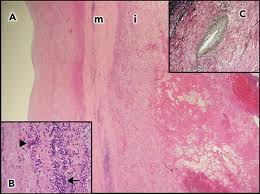 Image result for Cardiovascular Syphilis