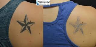 Tattoo Removal Sacramento Laser Tattoo Removal Sacramento Tattoo Removal Laser Tattoo Removal Laser Tattoo