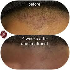 To get started, contact us by submitting the form below now so we can set up your consultation. Queens Laser And Electrolysis Hair Removal 30 Photos 77 Reviews Laser Hair Removal 87 08 Justice Ave Elmhurst Ny United States Phone Number Yelp