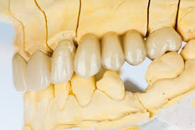 Maybe you would like to learn more about one of these? Restorative Dental Bridge Cary Nc Wake Dental Care