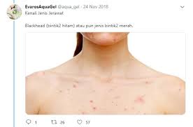 Maybe you would like to learn more about one of these? Nak Elak Jerawat Timbul Di Badan Guna 11 Produk Terbaik Yang Wanita Ini Sarankan Maskulin