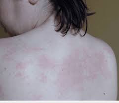 Image result for Generalized Rash