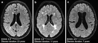 In the past few years, magnetic resonance imaging (mri) has become increasingly relevant in the diagnosis of multiple sclerosis (ms). Mri In The Diagnosis And Monitoring Of Multiple Sclerosis An Update Springerlink