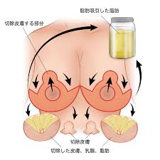 乳房吊り上げ・乳房縮小 | R.O.clinic | 表参道駅徒歩3分