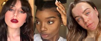 Beauty's role in the evolving category of acne