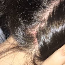 Are you still trying to figure out what little critters are bugging you? Are They Bugs I Babysit My Fiances Little Cousin And She Kept Itching So I Checked And She Has Little Black And White Looking Things And These Sores When I Took Out