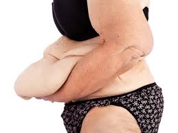 During the gastric sleeve procedure, the left side of the stomach is cut. How To Tighten Sagging Skin After Bariatric Surgery